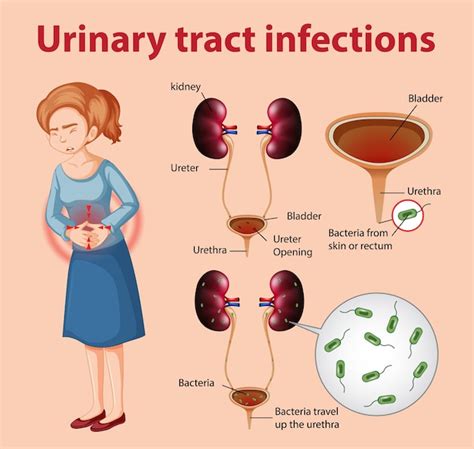 Understanding Urinary Tract Infections: Causes, Symptoms, and Treatments