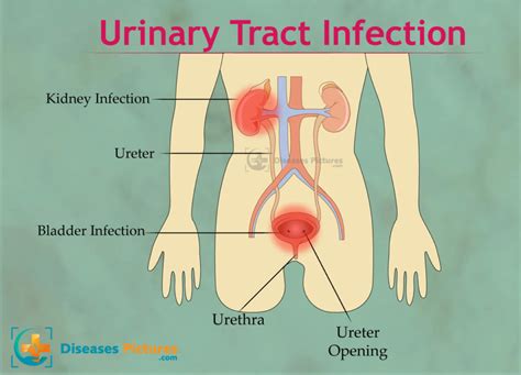 Understanding Urinary Tract Infections: Symptoms, Risks, and Treatments
