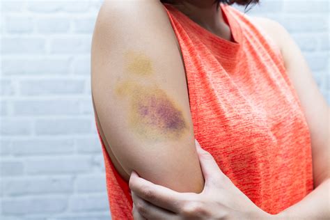 Understanding Why You Bruise Easily