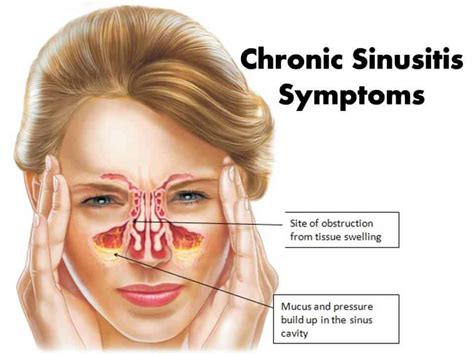 Understanding and Managing Chronic Sinusitis