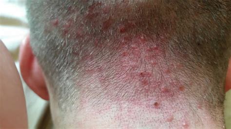 Understanding Folliculitis, Furuncles, and Carbuncles: Causes and Treatments