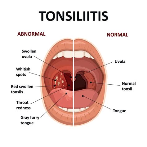 Understanding Tonsil and Adenoid Issues